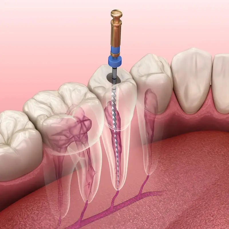 Root Canal by drcolleendonnelly in united states